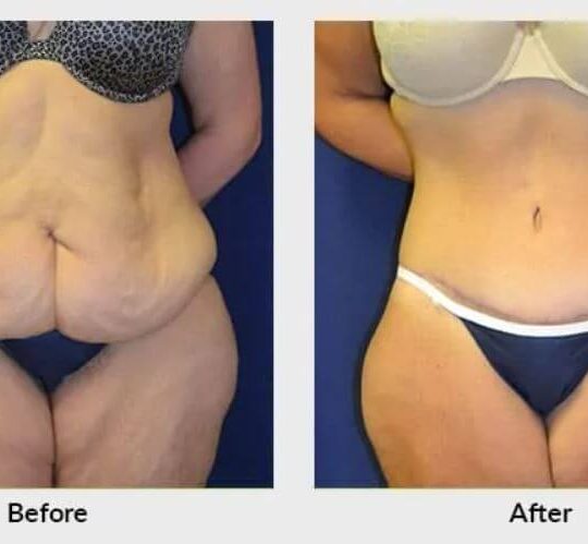 Aesthetic Surgery After Losing Weight 2 Aesthetic Surgery After Losing Weight 2
