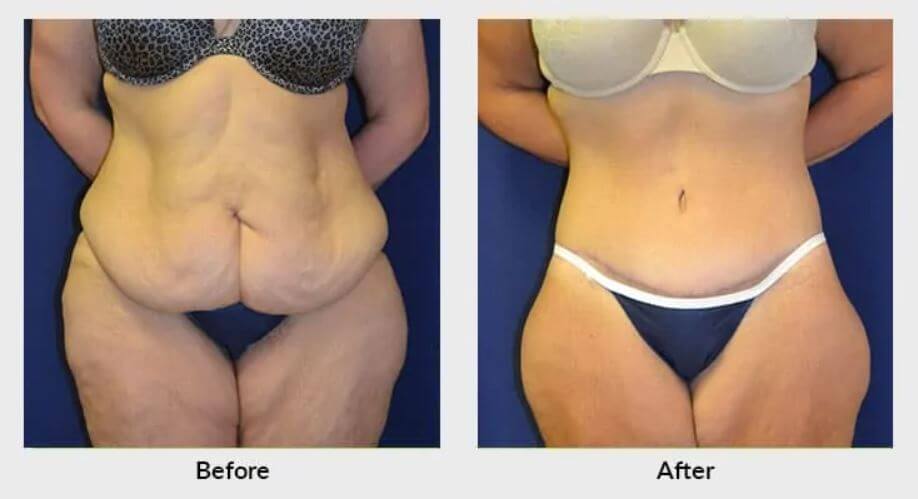 bathing suits after weight loss surgery