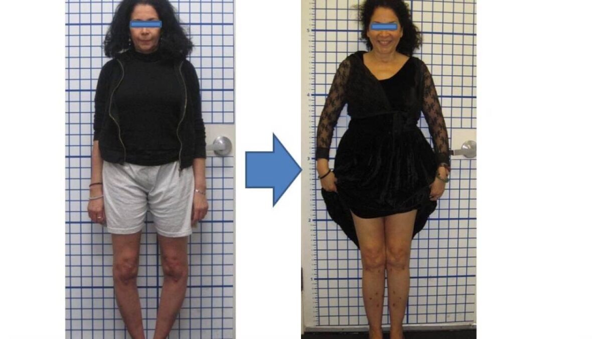 weight loss before and after women legs