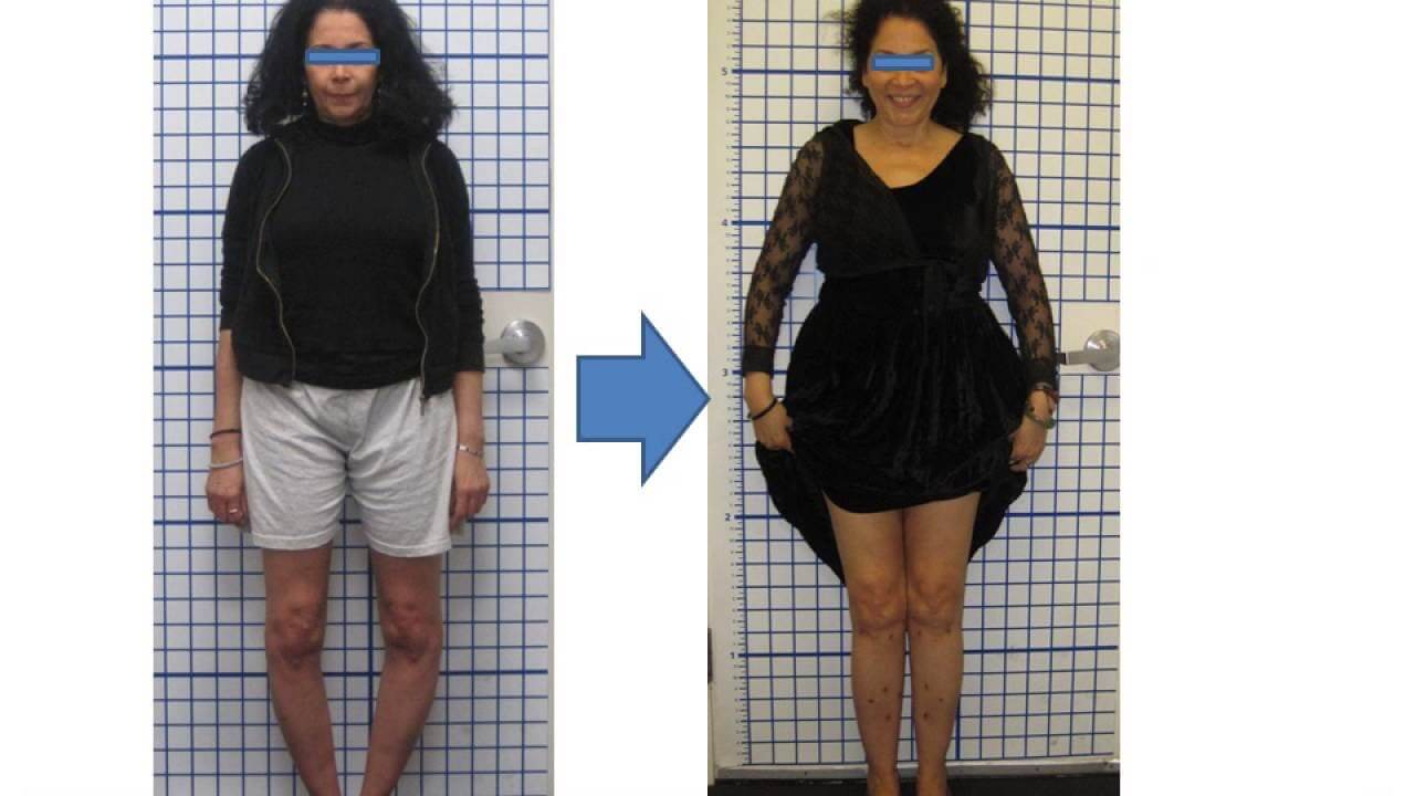 https://promarwellness.com/wp-content/uploads/2021/04/Bowlegs-Aesthetics-2.jpg