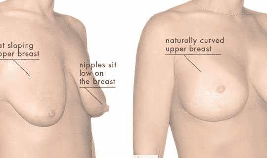 Breast Lifting - Promar Wellness