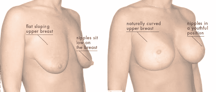 Breast Lifting - Promar Wellness