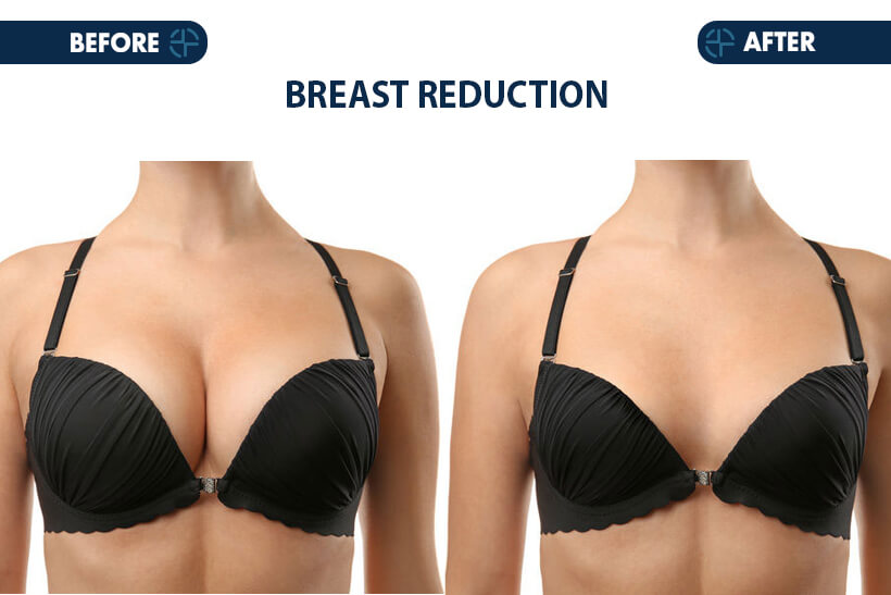 Breast Lifting - Promar Wellness