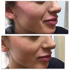 https://promarwellness.com/wp-content/uploads/2021/04/Cheek-Aesthetic-4.jpg