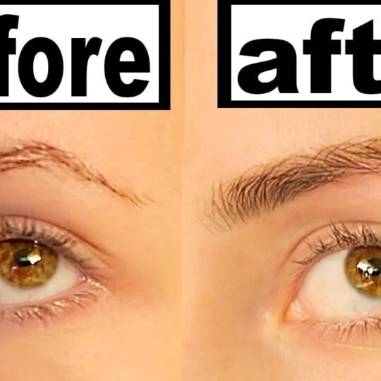 Eyebrow Lifting 2 Eyebrow Lifting 2