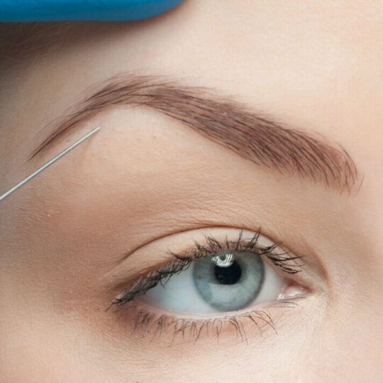 Eyebrow Lifting 3 Eyebrow Lifting 3