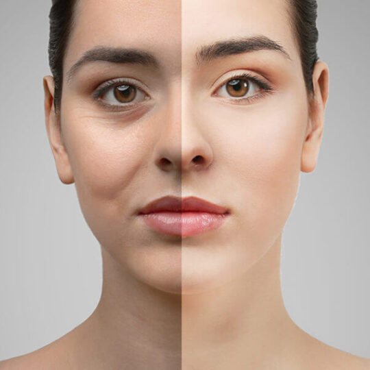 Eyelid surgery 2 Eyelid surgery 2