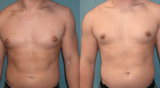 Gynecomastia 2 Gynecomastia 2