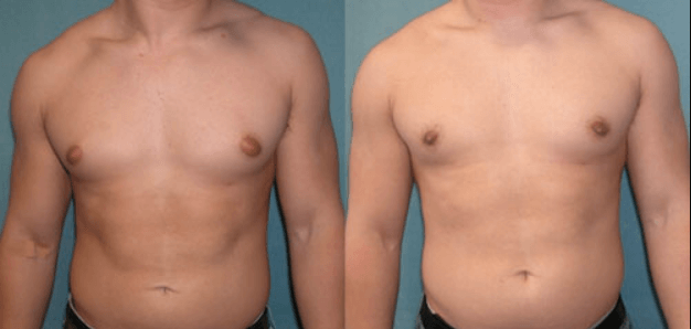 https://promarwellness.com/wp-content/uploads/2021/04/Gynecomastia-2-1.png