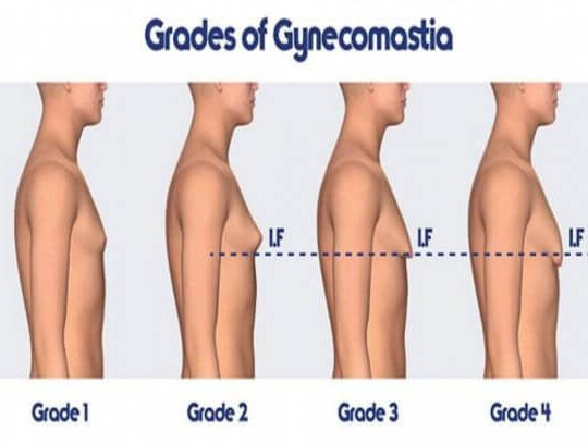 Gynecomastia 4 Gynecomastia 4