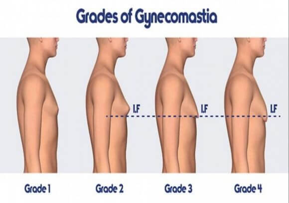 https://promarwellness.com/wp-content/uploads/2021/04/Gynecomastia-4-1.jpg