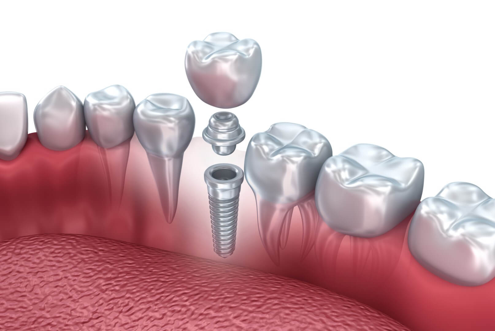 https://promarwellness.com/wp-content/uploads/2021/04/Implant-Applications-3.jpg