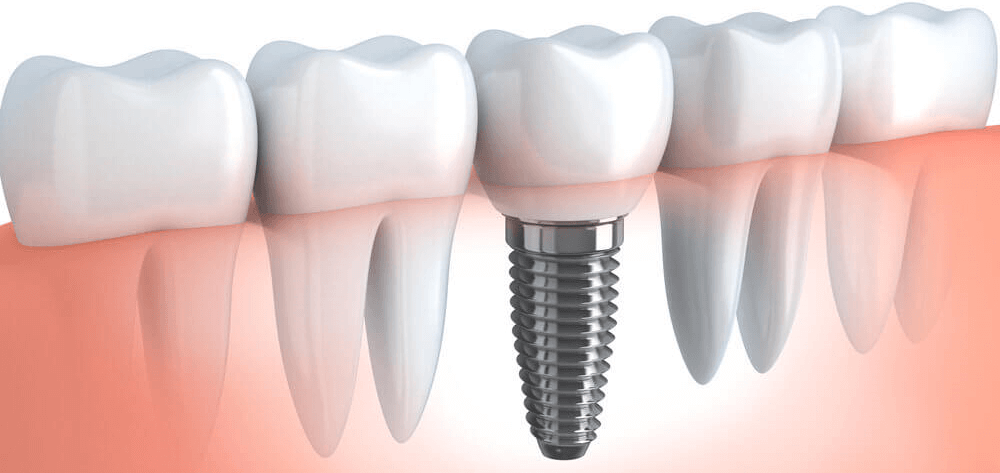 Implant Applications