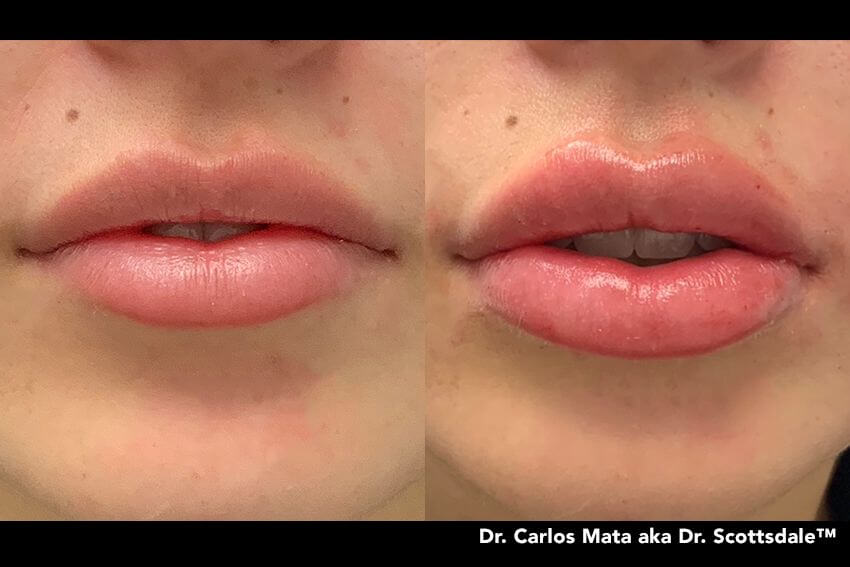 https://promarwellness.com/wp-content/uploads/2021/04/Lip-Enlargement-4.jpg