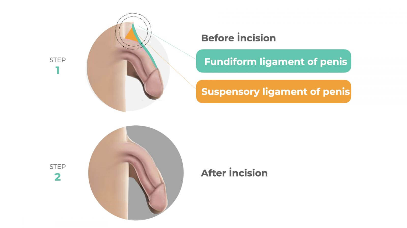 Cutting suspensory ligament before and after