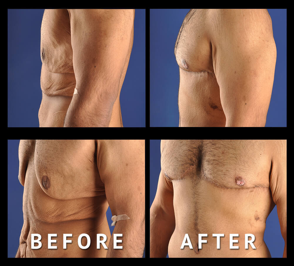 Post Bariatric Male Chest Re-shaping Using L-Shaped Excision Technique