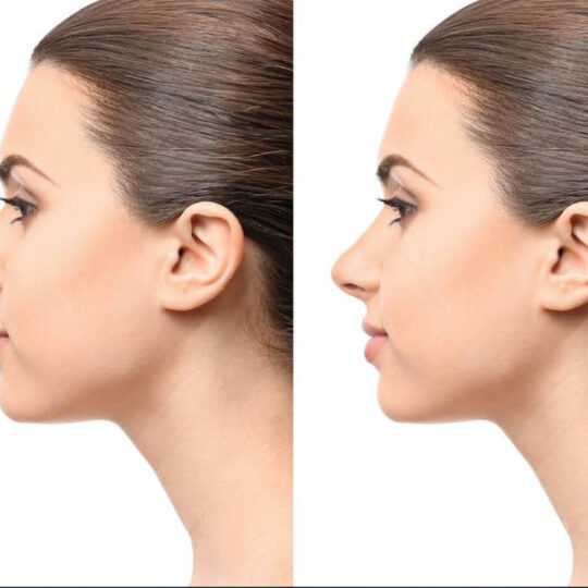 Rhinoplasty 3 Rhinoplasty 3