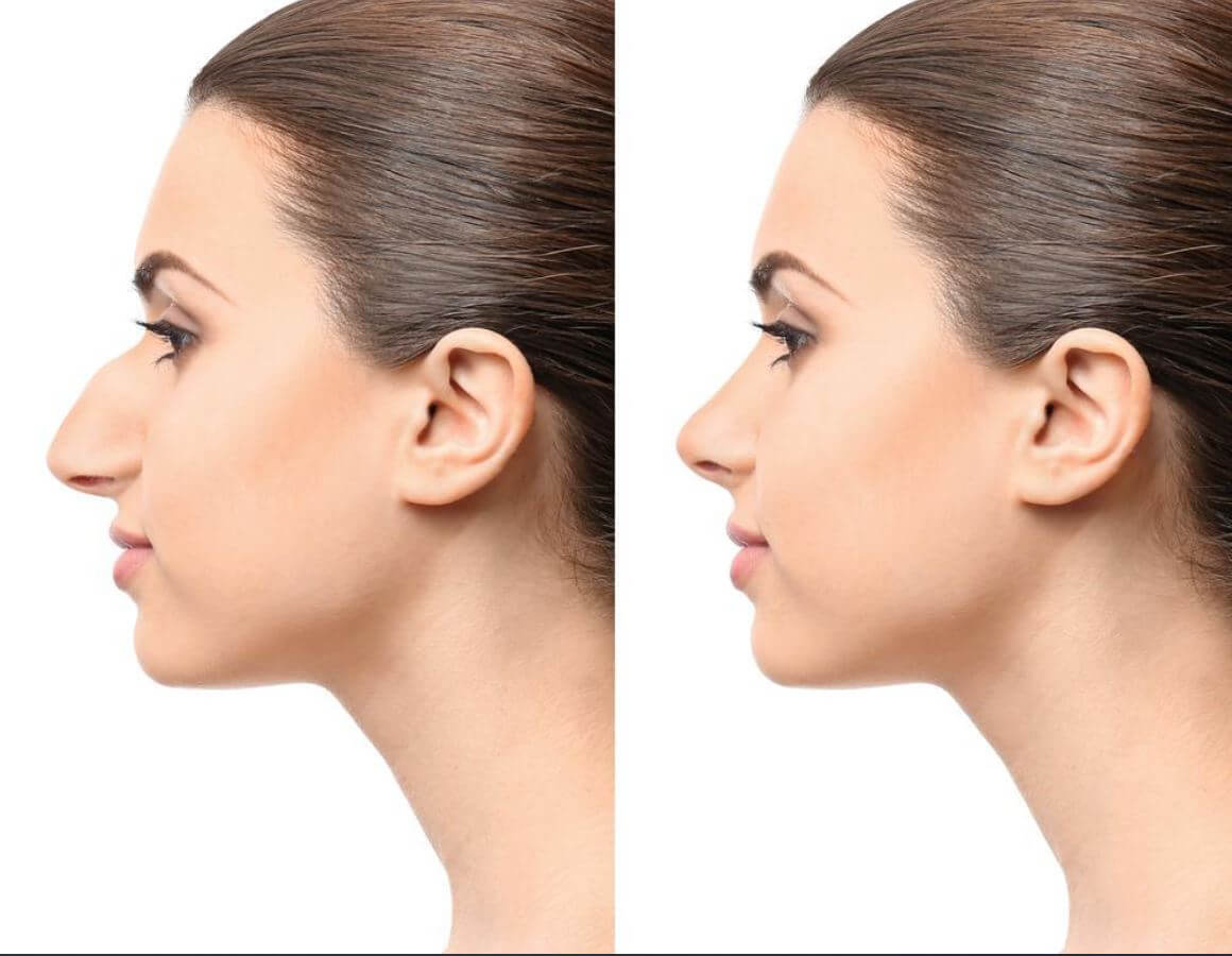 https://promarwellness.com/wp-content/uploads/2021/04/Rhinoplasty-3.jpg