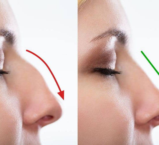 Rhinoplasty Without Surgery 2