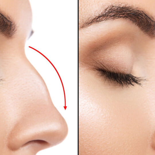 Rhinoplasty Without Surgery