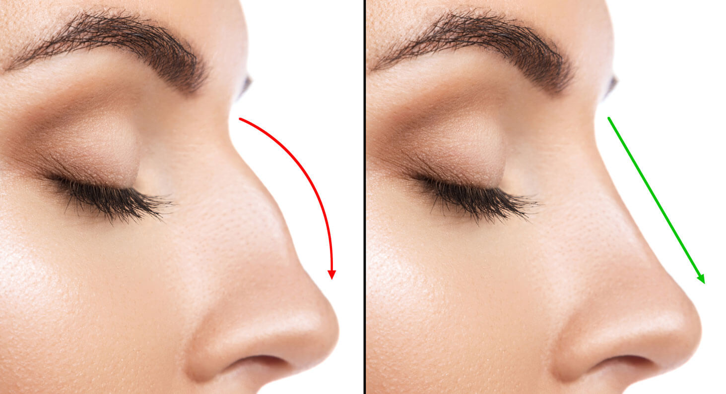 https://promarwellness.com/wp-content/uploads/2021/04/Rhinoplasty-Without-Surgery.jpg