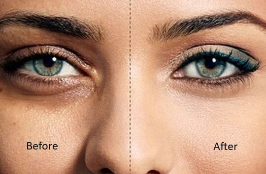Treatment of Dark Circle Under Eyes 2 Treatment of Dark Circle Under Eyes 2