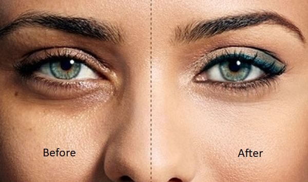 https://promarwellness.com/wp-content/uploads/2021/04/Treatment-of-Dark-Circle-Under-Eyes-2.jpg