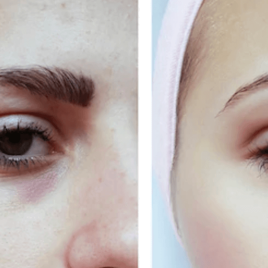 Treatment of Dark Circle Under Eyes 3 Treatment of Dark Circle Under Eyes 3