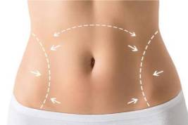 Tummy Tuck